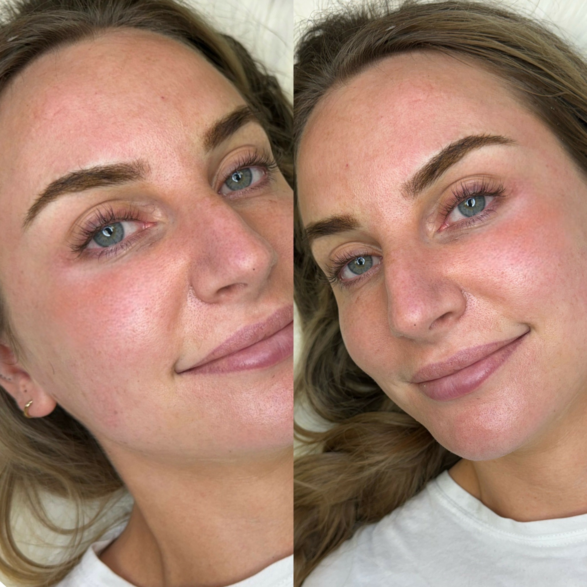Side-by-side images of a woman with clear skin and blue eyes, smiling in both photos.