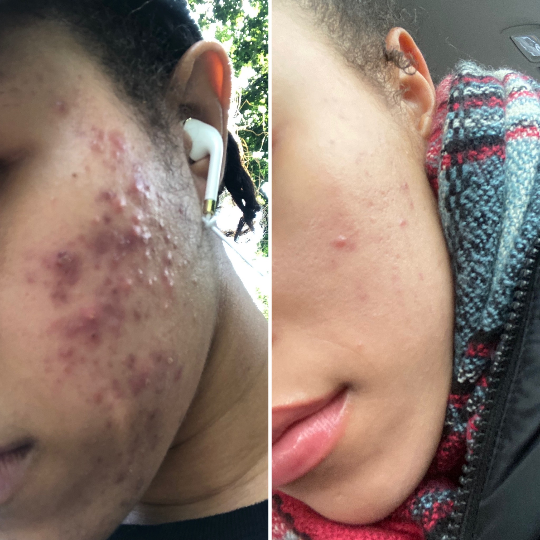 Comparison of skin before and after treatment showing reduced acne and scarring, close-up of a person's cheek and jawline.